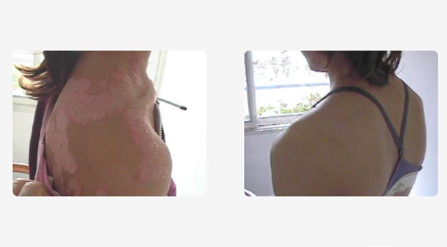 Psoriasis invertida
