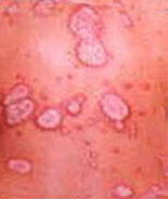 Piel con psoriasis